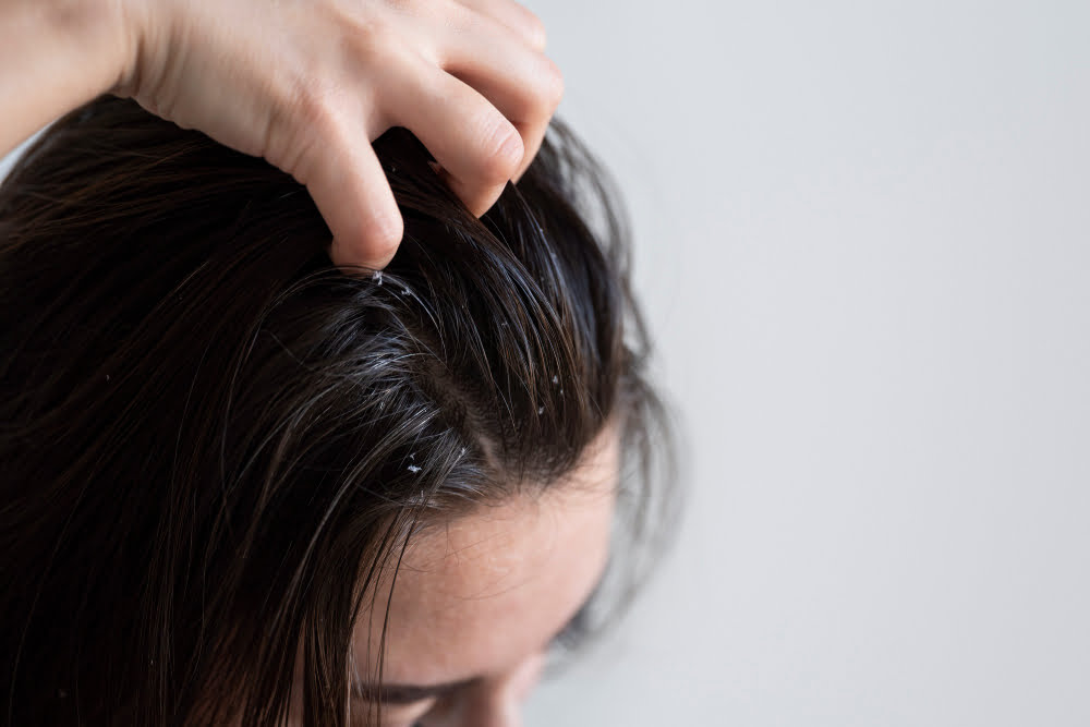 Person scratching their scalp due to dandruff, illustrating discomfort from dandruff and the need for a shampoo that is good for dandruff